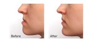 Orthognathic Surgery before and after