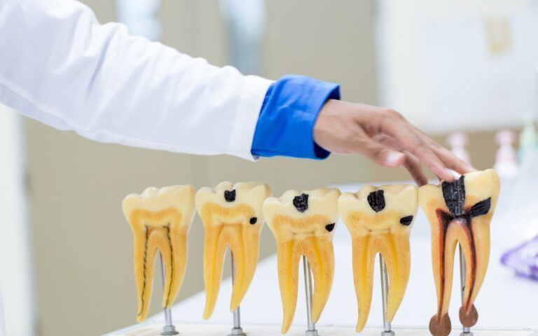 Stages of Tooth Decay